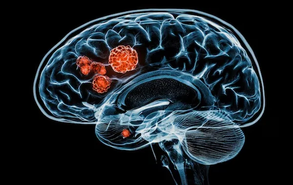 Brain Tumor Surgery