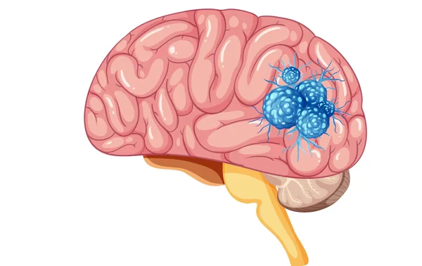 Glioma Surgery