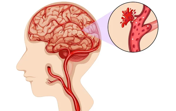 Brain Hemorrhage Surgery
