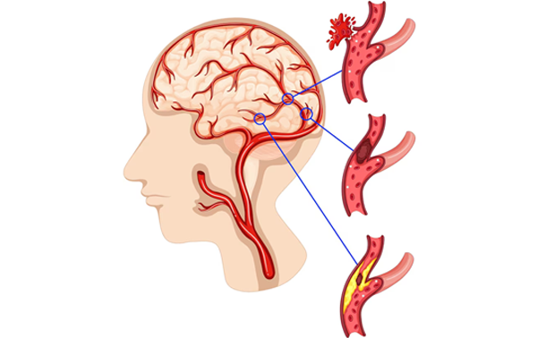 Brain Aneurysm  and AV Malformation Surgery
