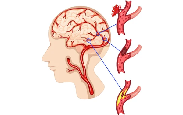 Brain Aneurysm  and AV Malformation Surgery