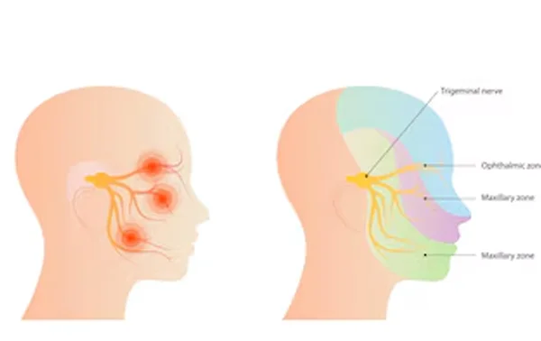 Trigeminal Neuralgia Surgery