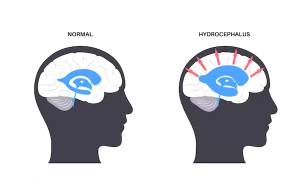 Hydrocephalus Surgery