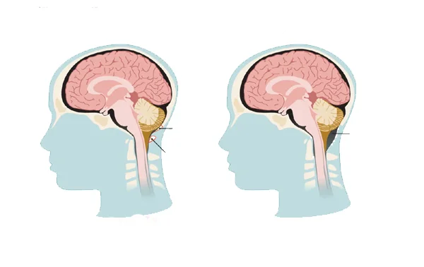 Arnold Chiari Malformation Surgery