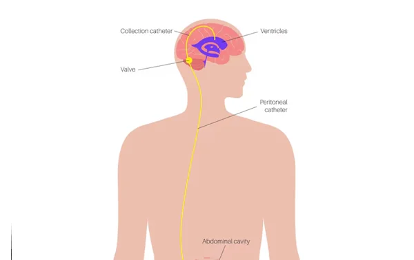 ETV or VP Shunt for Hydrocephalus