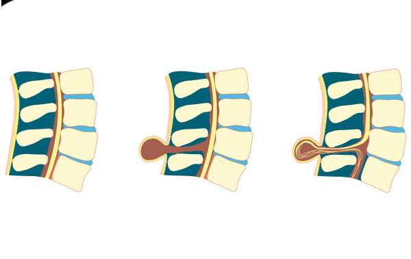 Spina Bifida or Meningocele or Myelomeningocele Surgery