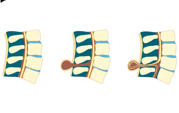 Spina Bifida or Meningocele or Myelomeningocele Surgery