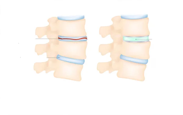 Disc Replacement Surgery